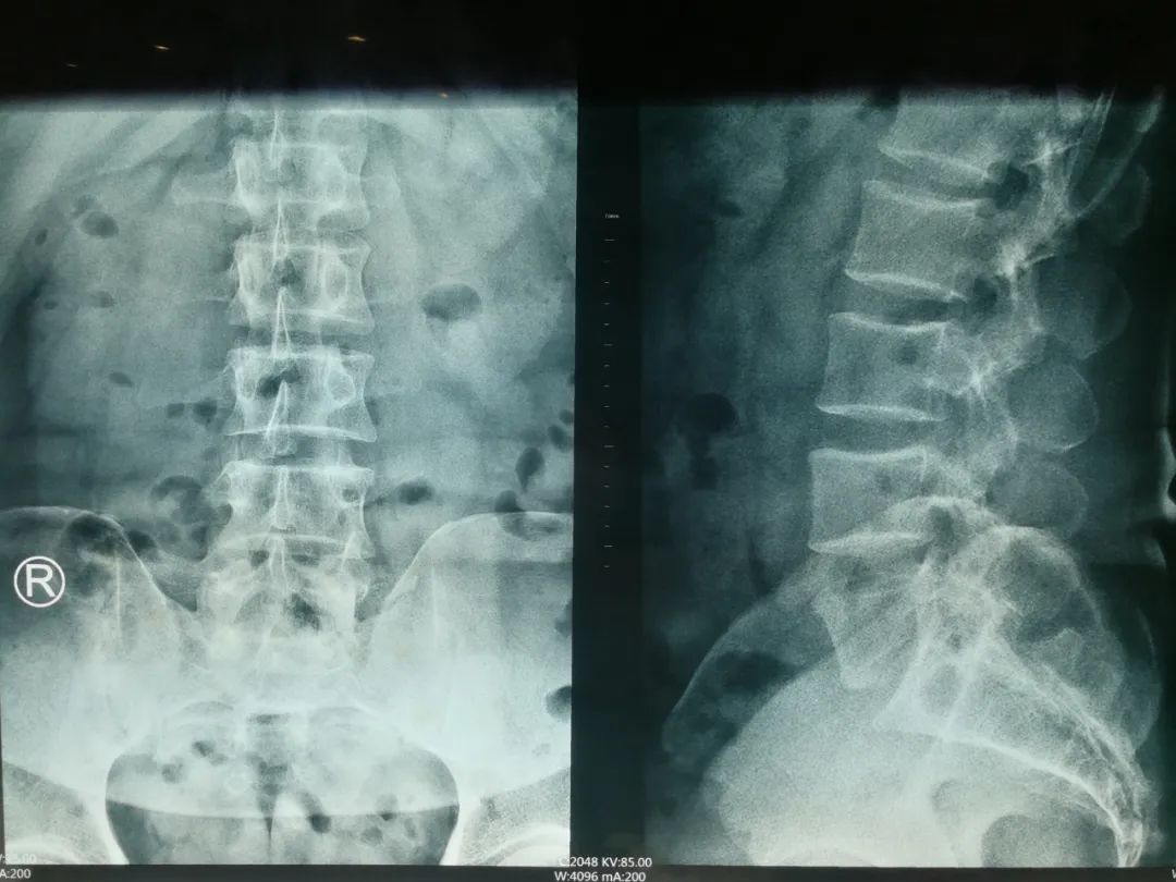 腰椎间盘突出症治疗，1个反射动作引出，提示治愈，医生很开心