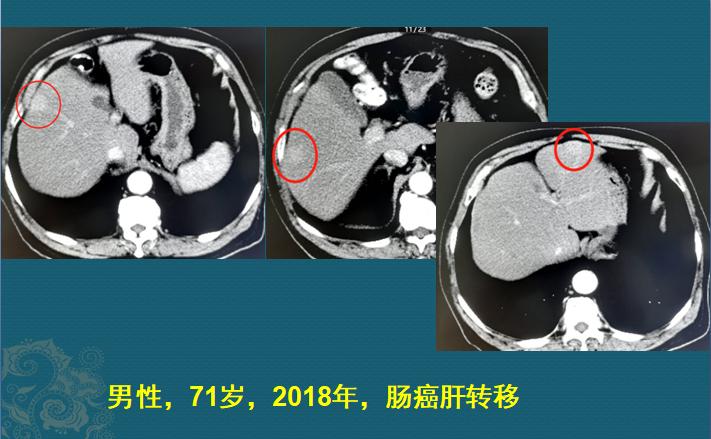 分享癌症患者康复,肿瘤病人的分享