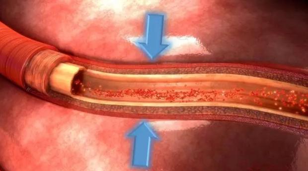 冠脉ct能看到血管粥样硬化,做冠脉ct能看出来心肌缺血吗