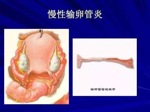 输卵管炎症一定要重视,输卵管炎症不用手术怎么治疗