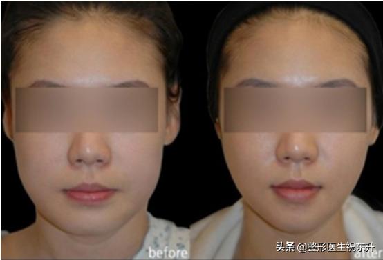 脸上打肉毒素瘦脸多久能见效,全脸打半支肉毒素可以瘦脸吗