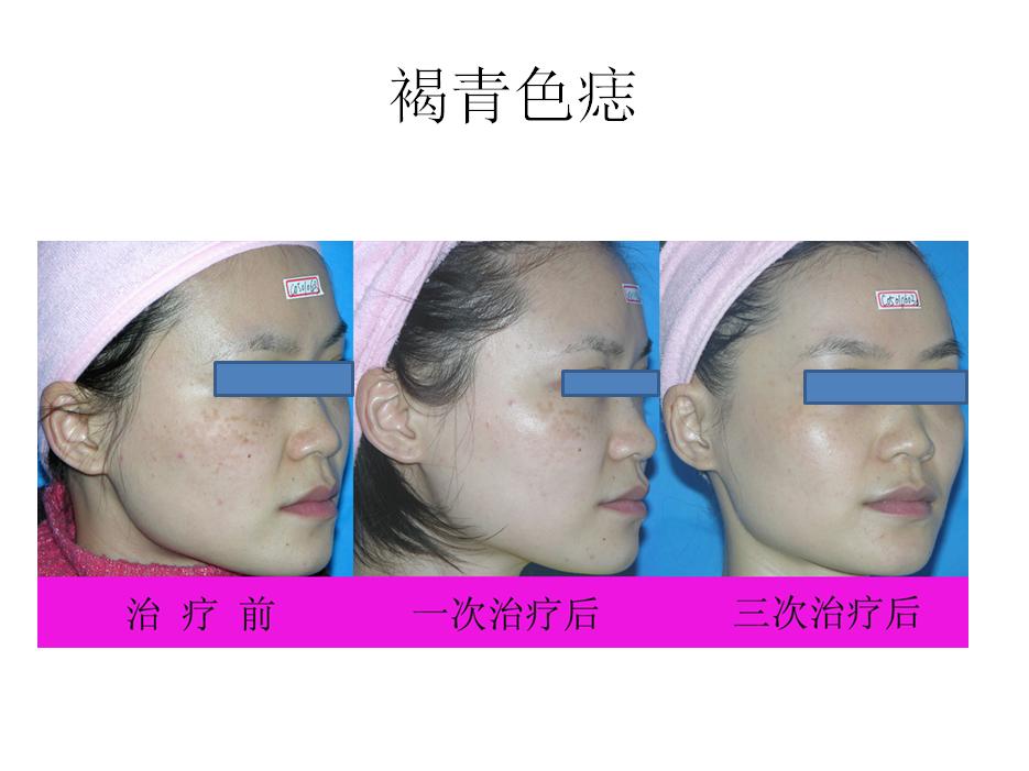 超皮秒华美,超皮秒专场直播