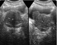 前列腺检查有杂菌怎样治疗,前列腺增生如何检查