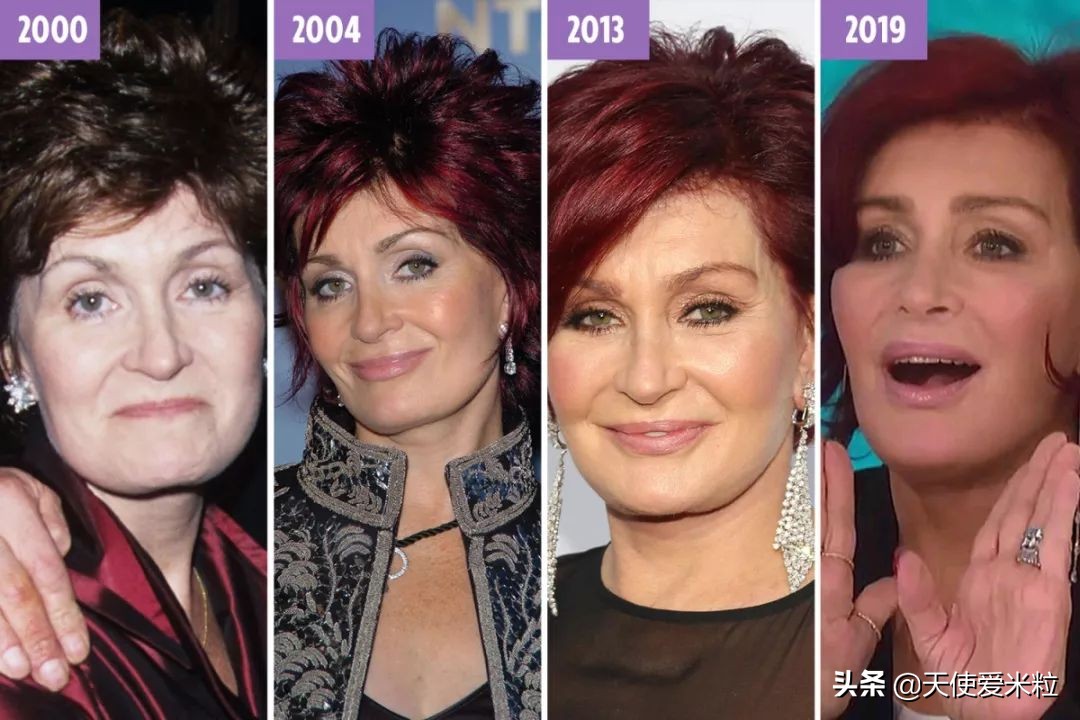 做了拉皮手术第九天疼,68岁女人拉皮手术后续