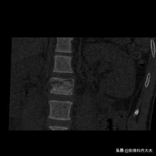 骨折的影像学检查及各自的优势,骨折的影像学愈合标准