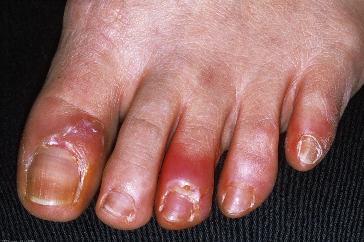 为什么会患上甲沟炎？孕妇患甲沟炎怎么办？