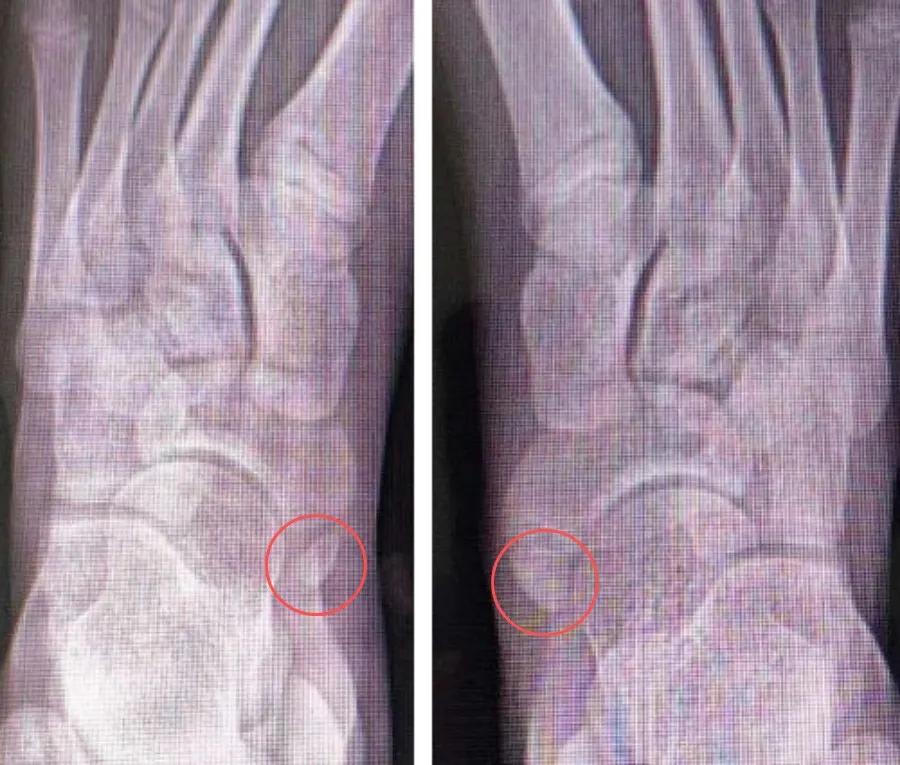 脚上多长了块骨头,腿关节多长了一块骨头