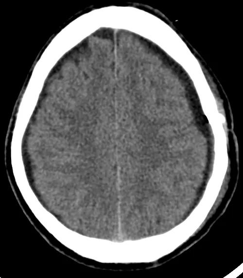 老人摔跤颅内轻微出血要紧吗,老人摔跤后后脑勺出血