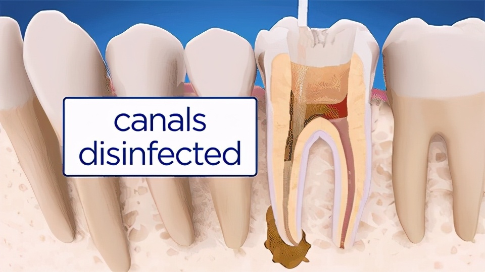 根管治疗可以在不同的地方吗,根管治疗是啥意思
