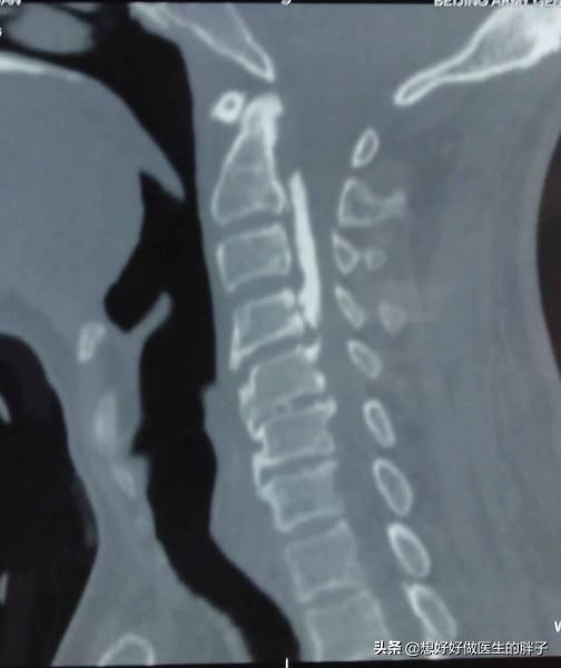 颈椎骨刺压迫神经怎么治疗,颈椎间盘突出压迫神经的症状