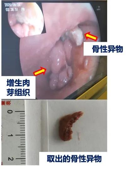 一碗鱼汤,让她反复咳嗽、发烧,还发生了食管、气管“短路”