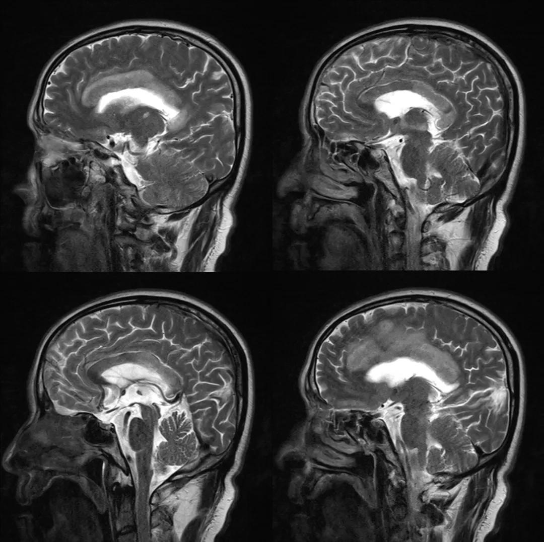 胼胝体有什么症状,胼胝体形态较小可以治疗吗