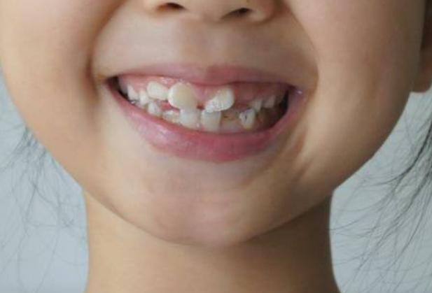 五岁宝宝牙缝越来越大,9岁孩子戴牙套的痛苦经历