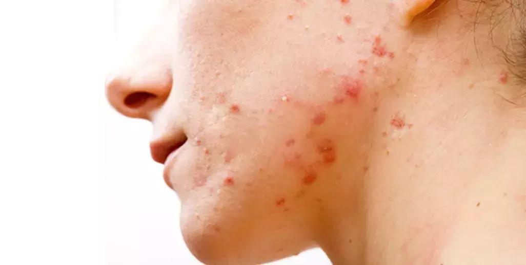 激素药膏太恐怖,激素药物那么可怕为什么要用激素