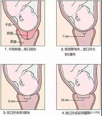 医生怎么判断孕妇开了几指,医生给孕妇检查开几指