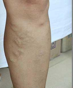 孕期走多路累会不会引起静脉曲张,孕期有什么方法缓解静脉曲张