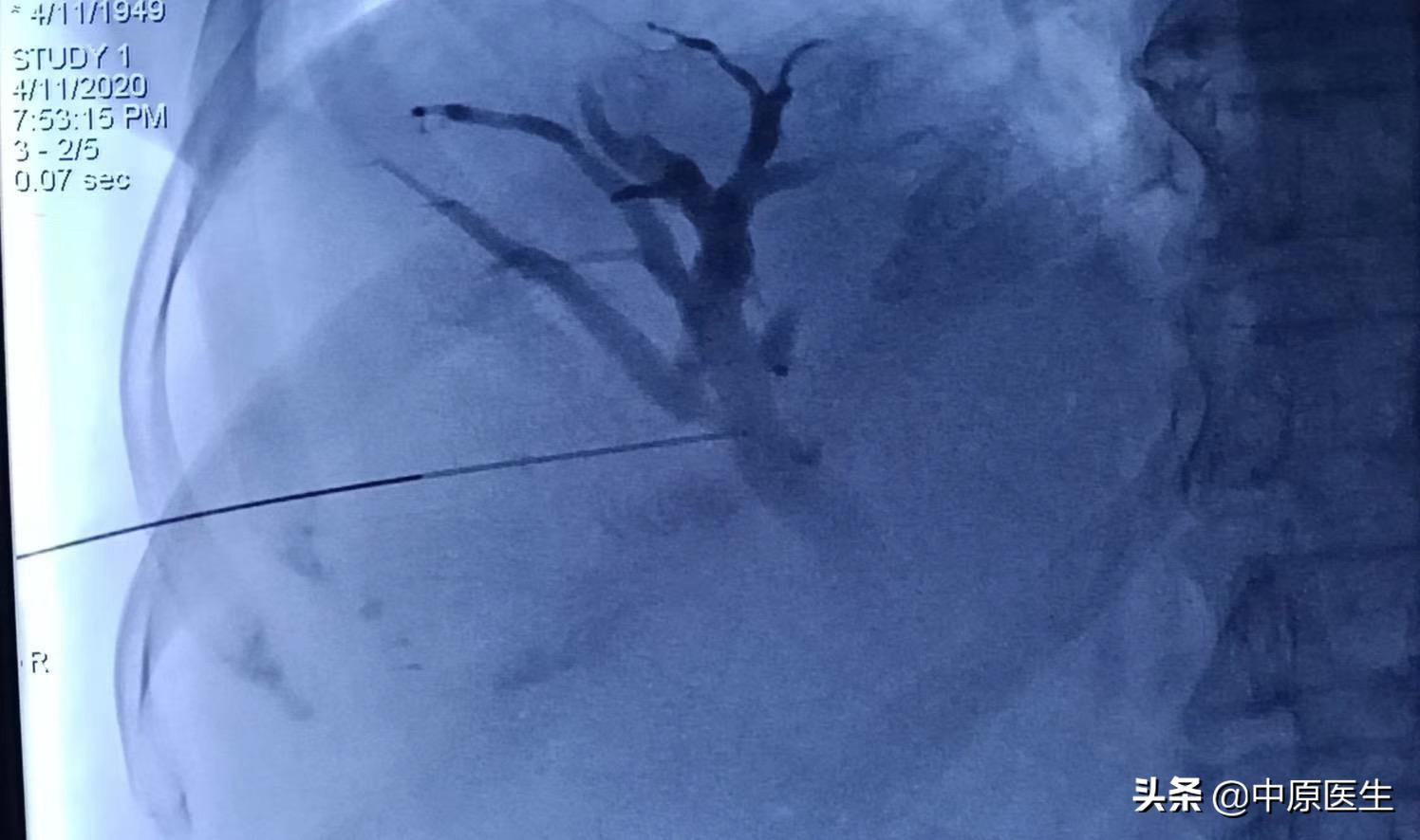 团队工作：老太太患黄疸规范治疗后仍高烧，转到介入科很快治好了