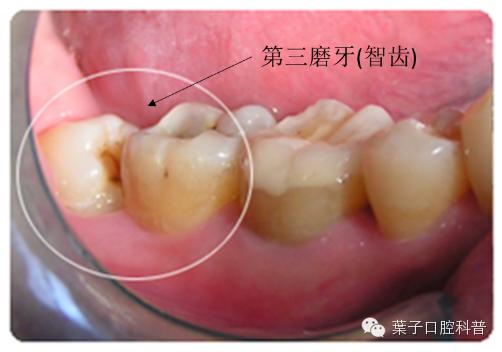 拔智齿：讳疾忌医有什么后果？#葉子口腔科普#