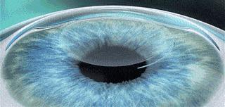 用激光治疗后发性白内障更模糊,患白内障造成看事物模糊