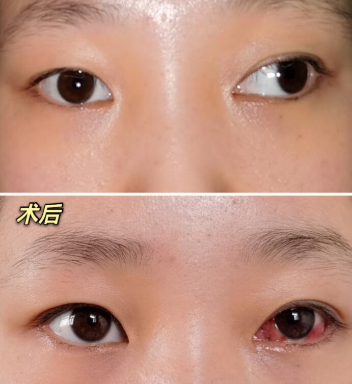 小孩眼睛斜视能不能矫正过来,宝宝眼睛斜视治疗费用