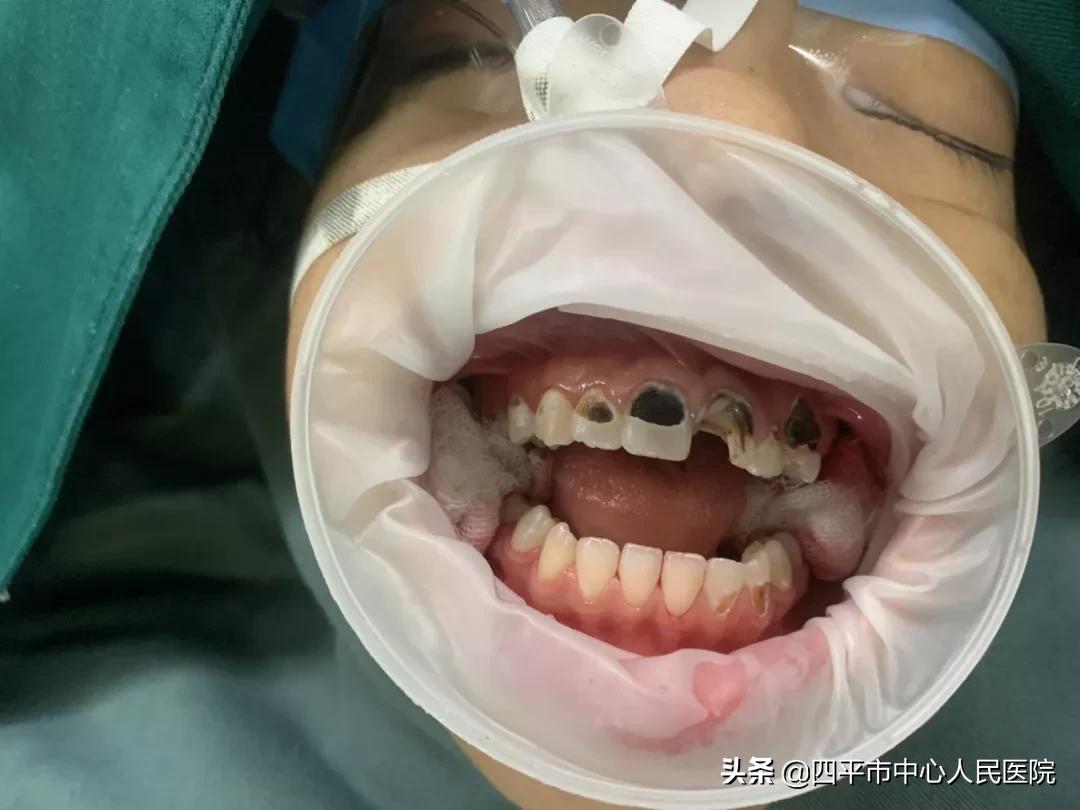 使用这个方法让孩子告别蛀牙,告别蛀牙洞