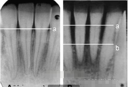 什么叫牙槽骨流失,牙槽骨吸收牙根露出来怎么办