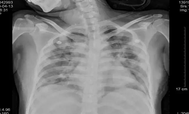 孕妇可以用奥司他韦预防流感吗,奥司他韦是孕妇禁用药吗