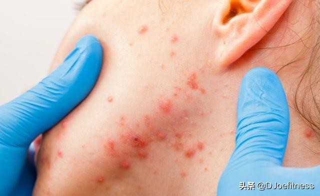 为什么健身喝蛋白粉容易长痘痘,健身喝蛋白粉怎么起痘痘