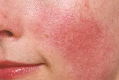 敏感肌推荐修复步骤,敏感肌修复技巧