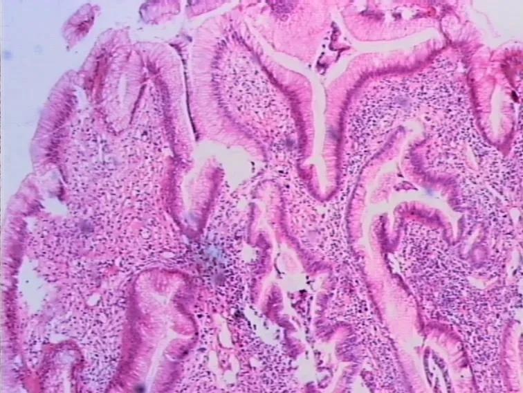 胃息肉癌变怎么治疗,胃息肉一定会癌变吗