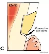 补楔状缺损的步骤,楔状缺损补牙过程