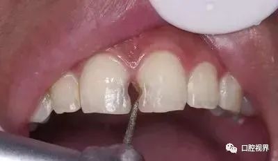 听说牙缝太大难看又露财，您给看看这牙缝还有救吗？