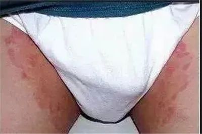 夏日如何远离体癣、花斑癣、股癣等各种皮肤癣的困扰