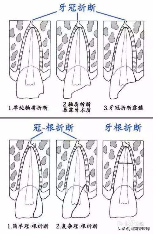 小朋友牙齿撞坏了怎么办,儿童牙齿摔掉了门牙怎么处理