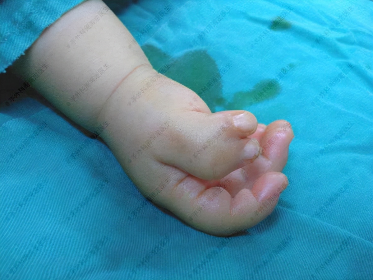 手多指同时脚也多指的婴幼儿多吗,婴儿多指并指多大手术最好