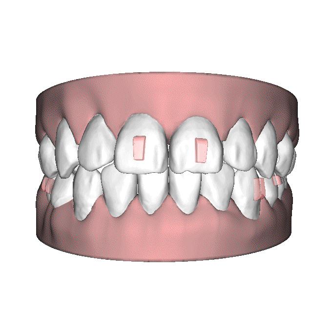 自锁托槽和隐形矫治器哪个效果好,无托槽隐形矫治器效果好吗