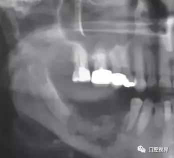 服用阿司匹林期间拔牙出血咋办,吃双膦酸盐类药物能拔牙吗