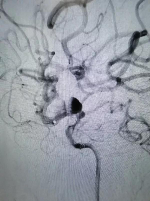 山东大学齐鲁医院王东海教授团队成功治疗多发性动脉瘤