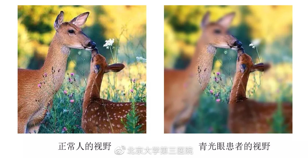 视野不丢，生活无忧|“大夫，我最近看灯光时四周总是有彩虹一样的七彩光晕，有问题吗？”