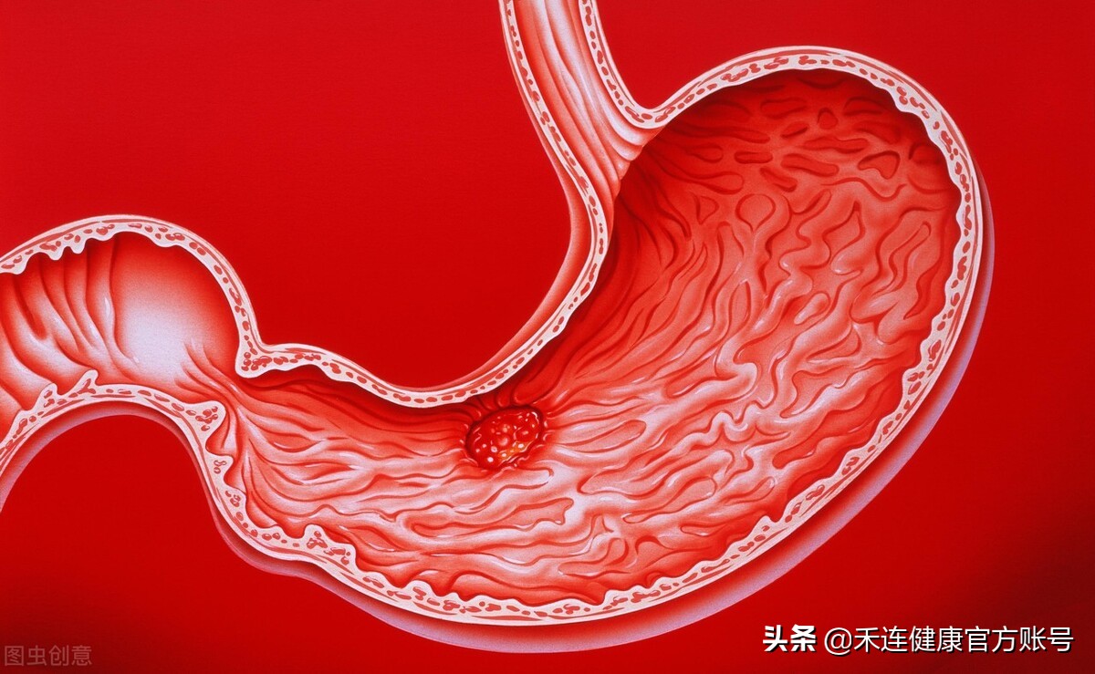 幽门螺旋杆菌阳性不治能好吗,c13幽门螺杆菌检测阳性致癌