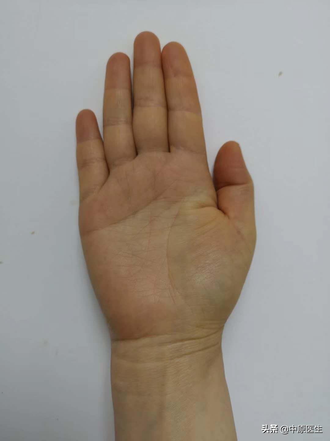 女人手黄脚底黄是什么原因,女性手黄是黄疸吗