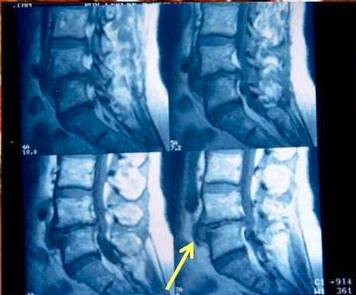 腰椎间盘突出症的临床诊治策略,腰椎间盘突出症的临床诊治