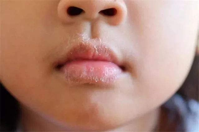宝宝湿疹干红粗糙怎么办,宝宝皮肤干红起皮怎么办