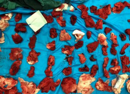 被剪刀刺的男孩怎么样了,被剪刀戳了3毫米深的伤口