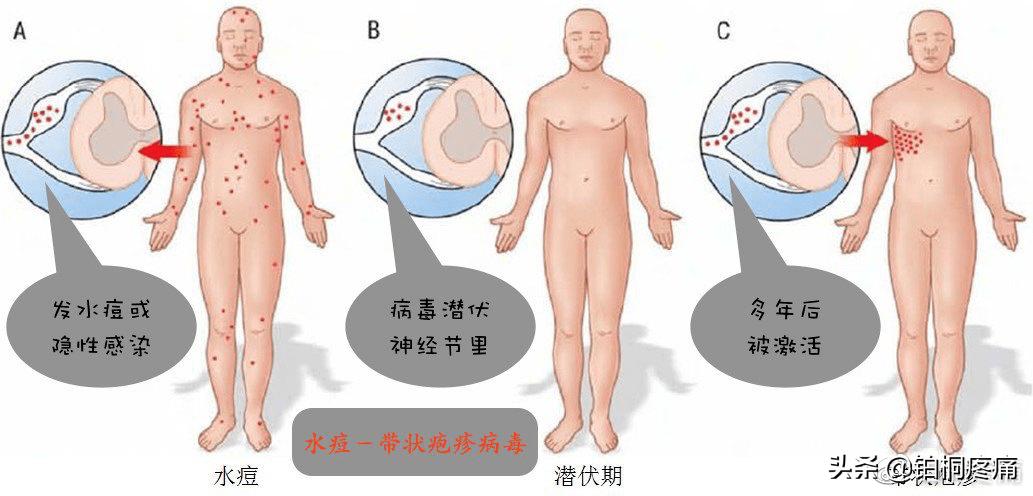 得了带状疱疹疼痛怎么办,带状疱疹有一点痛是不是快好了