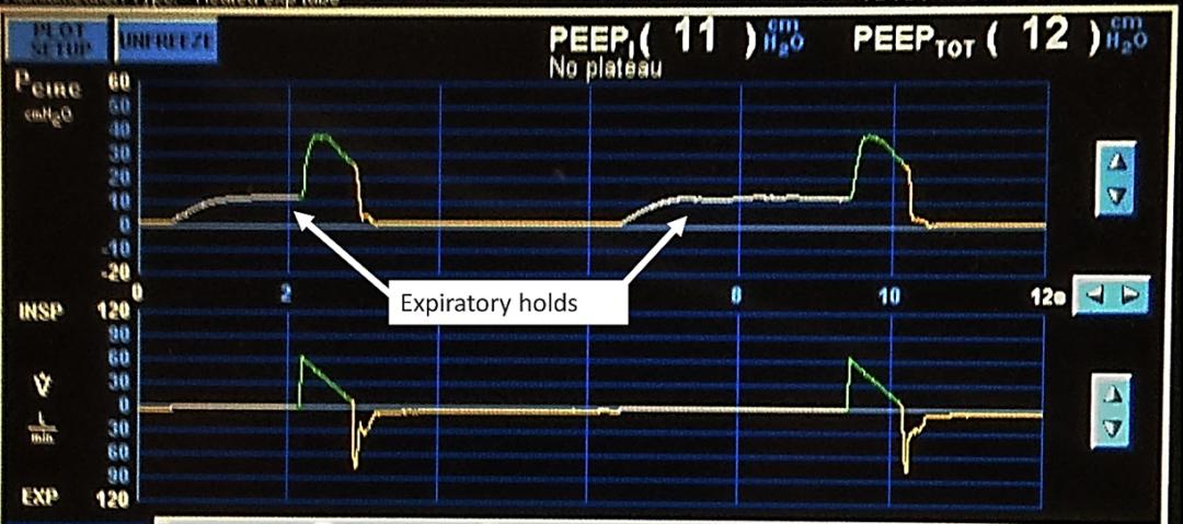 新冠肺炎机械通气系列课程(讲义)-阻塞性肺病的机械通气