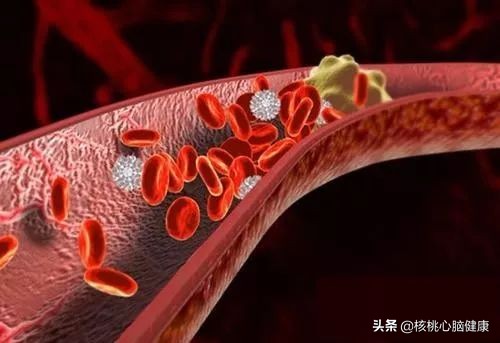 突发脑梗怎么急救最好的方法,疏通血管的药水对脑梗有好处吗