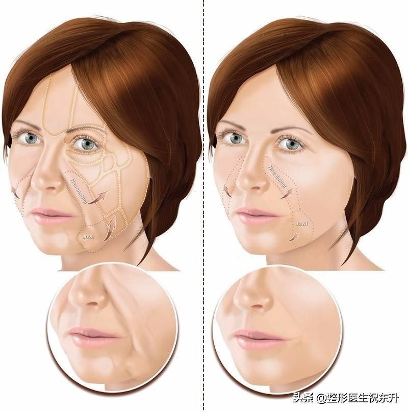 去法令纹最有效的办法亲测,法令纹抬头纹怎么去除最好的方法