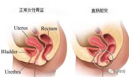 医学科普便秘篇之--直肠前突