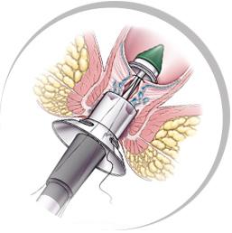 得痔疮必须要做手术吗,得了痔疮有必要做手术吗